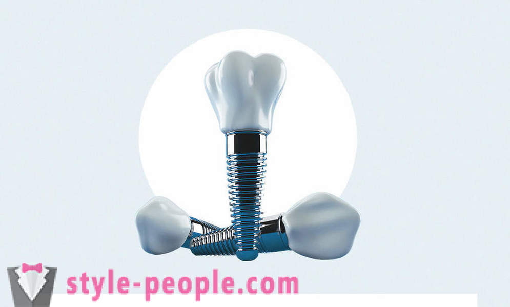 8 otázok o dentálne implantáty