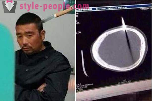 Číňan s nožom v hlave šiel k lekárovi