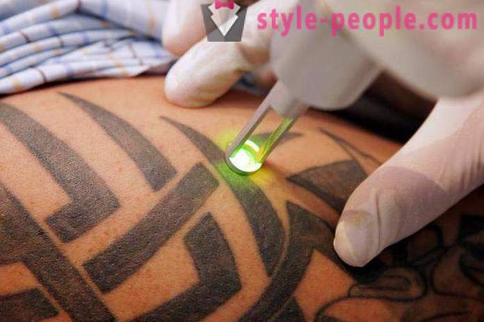 Laserové odstránenie tetovania. preskúmala