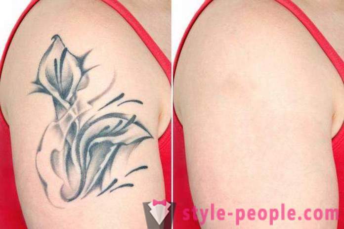 Laserové odstránenie tetovania. preskúmala