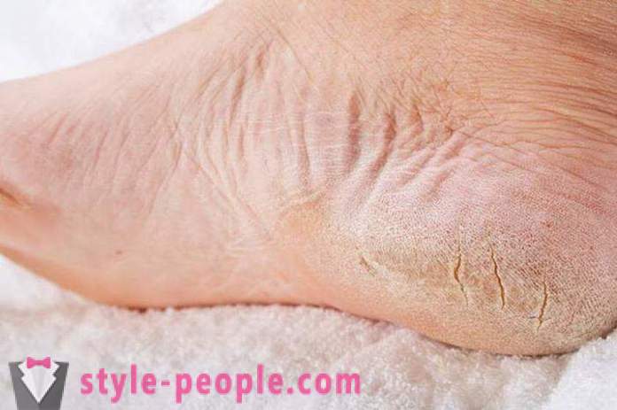 Suchá koža na nohách: Príčiny