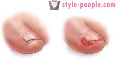 Zarastený necht na palci na nohe: príčiny a liečba