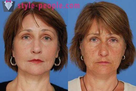 Laser resurfacing tváre - bezpečný spôsob, ako omladiť