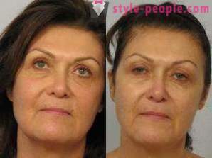 Laser resurfacing tváre - bezpečný spôsob, ako omladiť