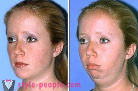Ako odstrániť tváre bez chirurgického zákroku